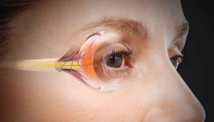 Глаукома на глазе